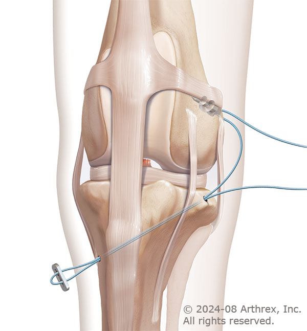 canine-cranial-cruciate-ligament-repair-surgery-small-dog illustration of canine-cranial-cruciate-ligament-repair-surgery-small-dog