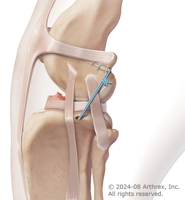 canine-cranial-cruciate-ligament-repair-surgery-small-dog illustration canine-cranial-cruciate-ligament-repair-surgery-small-dog